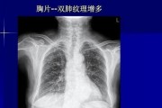 肺部出现问题，四肢会有哪些表现？别等到晚期才发现