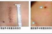 贲门癌全切后转移的症状与痛苦缓解治疗策略