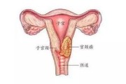 宫颈癌术后左腿沉重，是怎么回事？