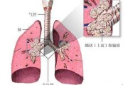 肺癌转移吃中药能治吗？可以控制病情吗