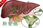 胃癌术后淋巴转移该怎么办？怎样治能控制病情发展