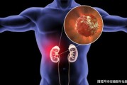 肾癌治疗后年不复发并非终点，持续关注与管理至关重要